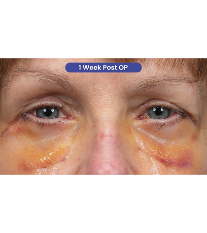 Lower Blepharoplasty Before & After Patient #3887