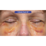 Lower Blepharoplasty Before & After Patient #3887