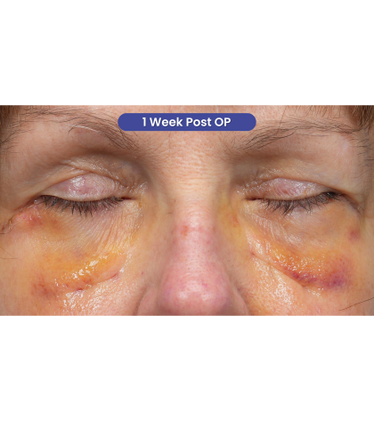 Lower Blepharoplasty Before & After Patient #3887