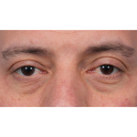 Ptosis Repair Before & After Patient #3912