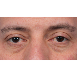 Ptosis Repair Before & After Patient #3912