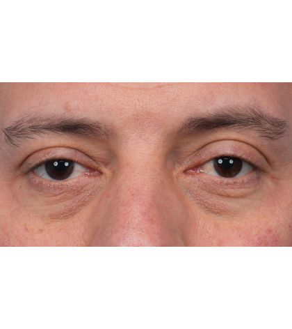 Ptosis Repair Before & After Patient #3912