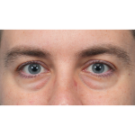 CO2 Laser Resurfacing Before & After Patient #3922