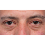 Ptosis Repair Before & After Patient #3912