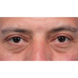 Ptosis Repair Before & After Patient #3912