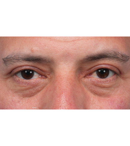 Ptosis Repair Before & After Patient #3912