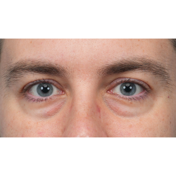 CO2 Laser Resurfacing Before & After Patient #3922