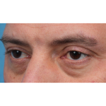 Ptosis Repair Before & After Patient #3912