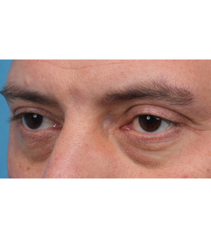 Ptosis Repair Before & After Patient #3912