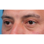 Ptosis Repair Before & After Patient #3912