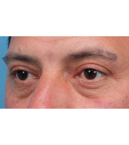 Ptosis Repair Before & After Patient #3912
