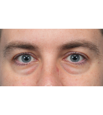 CO2 Laser Resurfacing Before & After Patient #3922