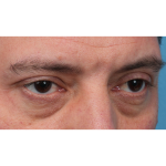 Ptosis Repair Before & After Patient #3912