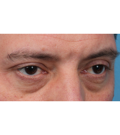 Ptosis Repair Before & After Patient #3912