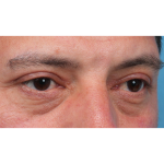 Ptosis Repair Before & After Patient #3912