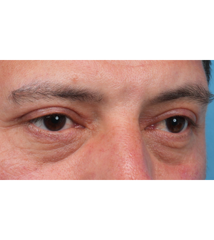 Ptosis Repair Before & After Patient #3912