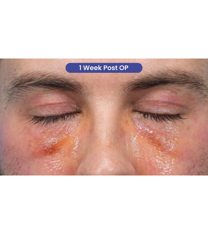 CO2 Laser Resurfacing Before & After Patient #3922