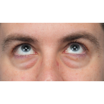 CO2 Laser Resurfacing Before & After Patient #3922