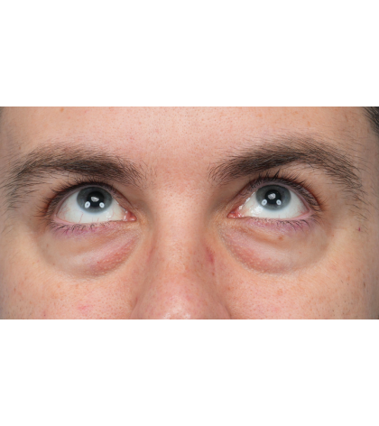 CO2 Laser Resurfacing Before & After Patient #3922