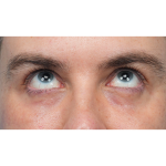 CO2 Laser Resurfacing Before & After Patient #3922