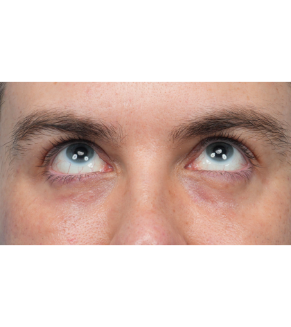 CO2 Laser Resurfacing Before & After Patient #3922