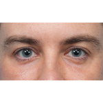 CO2 Laser Resurfacing Before & After Patient #3922