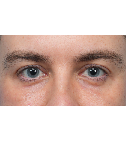 CO2 Laser Resurfacing Before & After Patient #3922