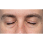 CO2 Laser Resurfacing Before & After Patient #3922