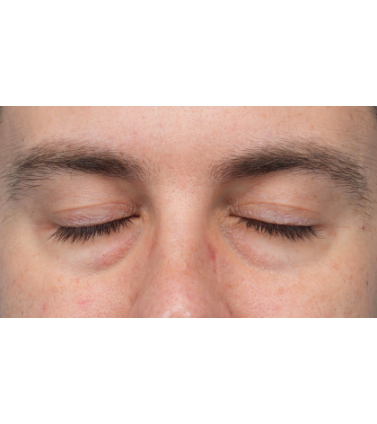 CO2 Laser Resurfacing Before & After Patient #3922