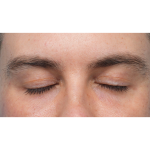 CO2 Laser Resurfacing Before & After Patient #3922
