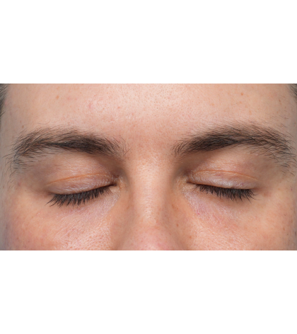 CO2 Laser Resurfacing Before & After Patient #3922