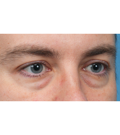 CO2 Laser Resurfacing Before & After Patient #3922