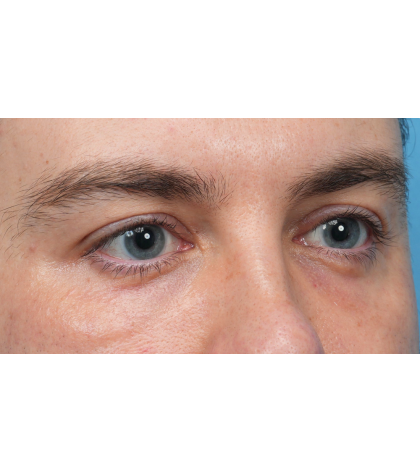 CO2 Laser Resurfacing Before & After Patient #3922