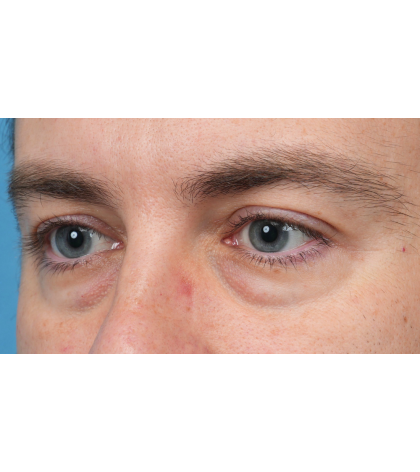 CO2 Laser Resurfacing Before & After Patient #3922