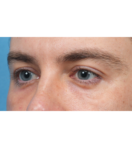 CO2 Laser Resurfacing Before & After Patient #3922