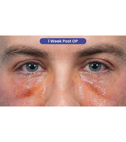 CO2 Laser Resurfacing Before & After Patient #3922